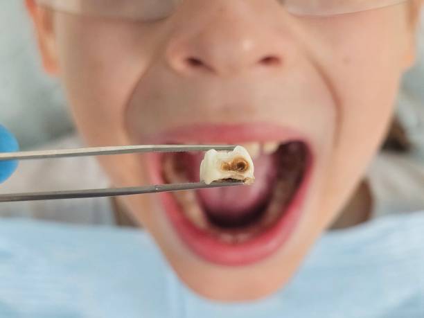 Best Emergency Dental Care for Broken or Chipped Teeth in Bowling Green, KY